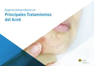 Tratamiento del Acné: Curso Online
