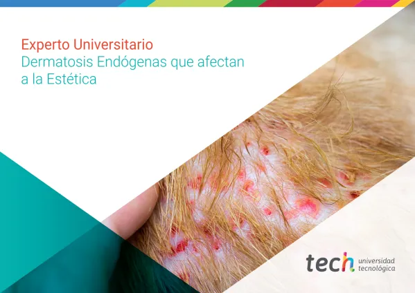 Experto Universitario Dermatosis Endógenas que afectan a la Estética
