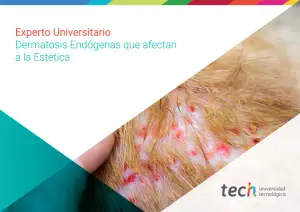 Dermatosis Endógenas: Curso Online